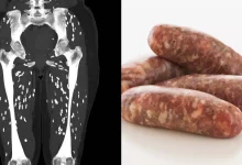 Photo of Horrifying scan shows what could happen to your body when you undercook your pork sausages